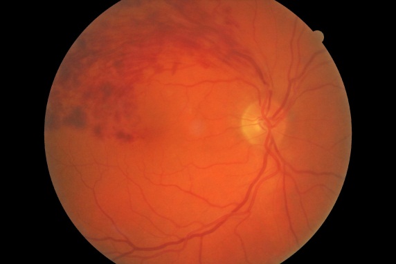 Eyescape Retinal Exams - Optometrist in Clarksburg Walmart